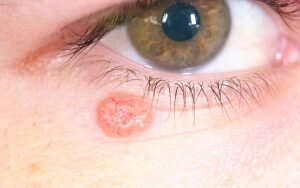 Аллергия на коже: симптомы и причины | Диагностика и лечение кожной аллергии в АО «Медицина»