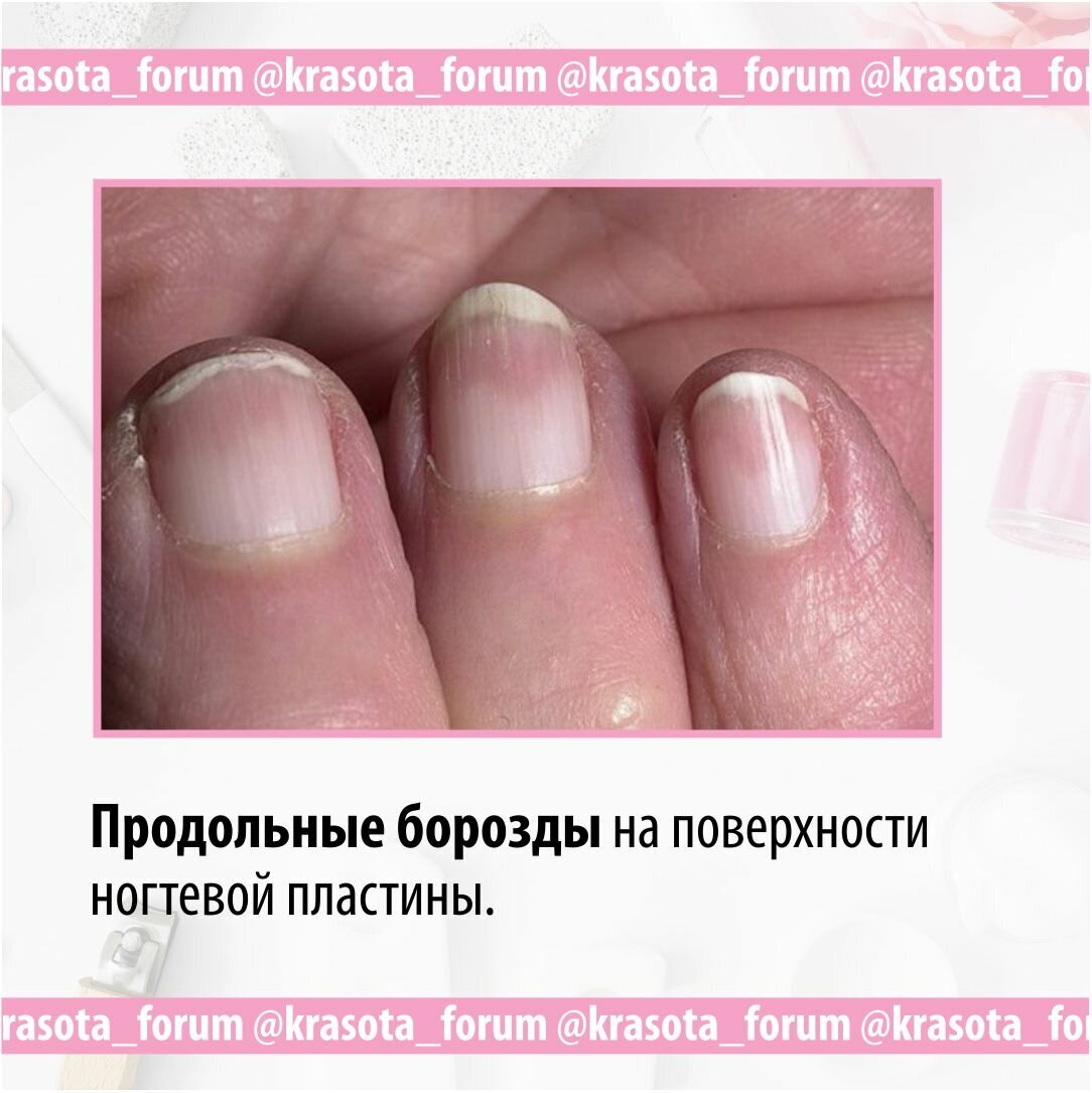 Почему на ногтях появляются продольные. Продольные борозды на ногтях. Продольные бороздки на ногтях. Продольные желобки на ногтях. Продольные борозды на ногтях рук.
