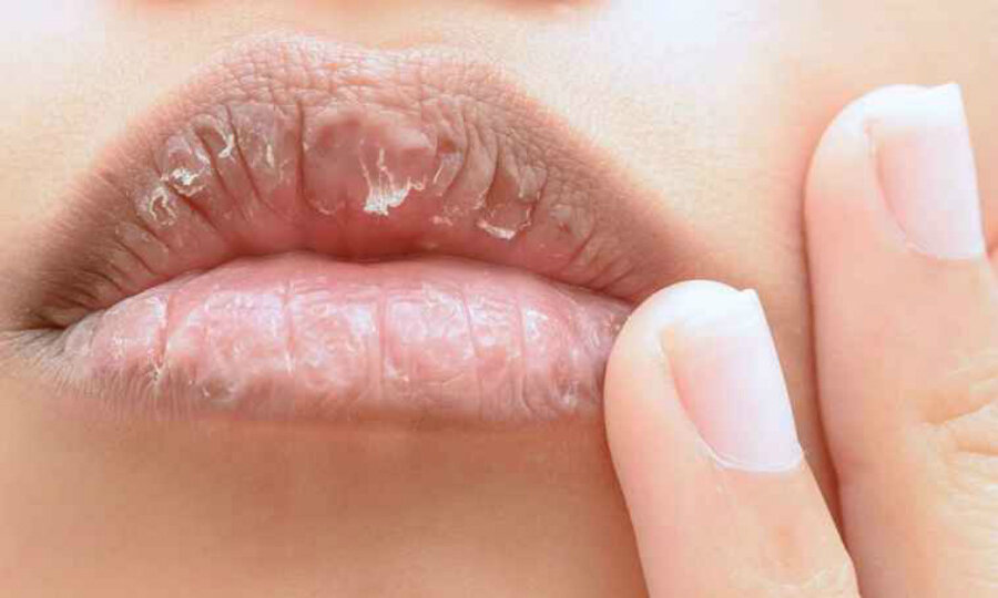 Уход за губами: что делать, если трескаются губы