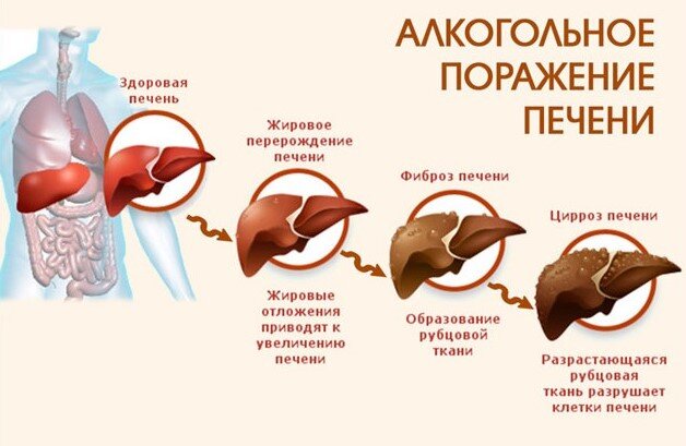 Алкогольная болезнь печени