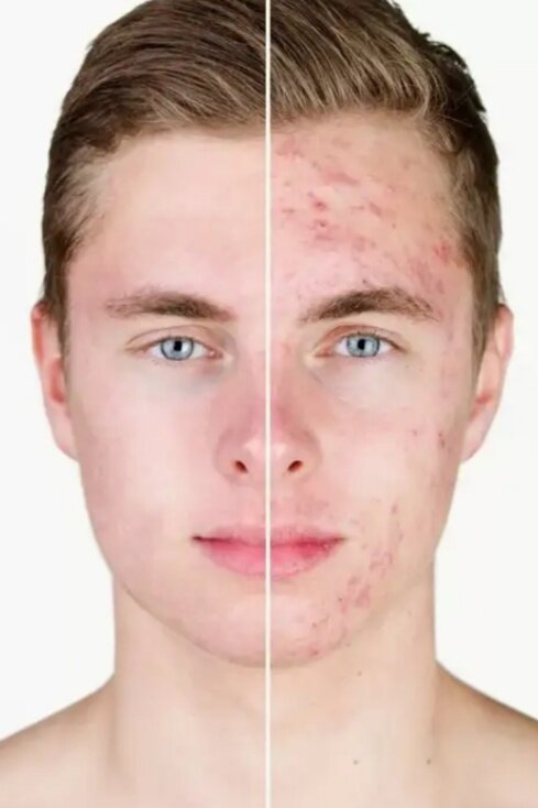 Высыпаний на коже - прыщи, угри, акне, гнойники