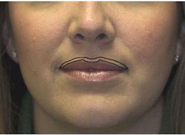 Как происходит процесс увеличения губ с помощью филлеров