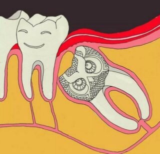 Зубы мудрости: удалить или вылечить?