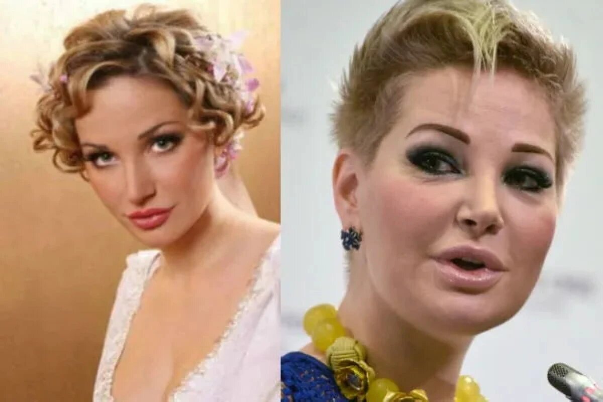 Довлатова после пластики фото: найдено 88 картинок