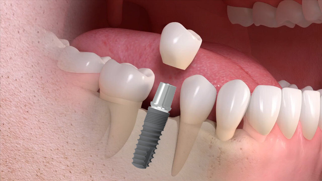 зубной имплант