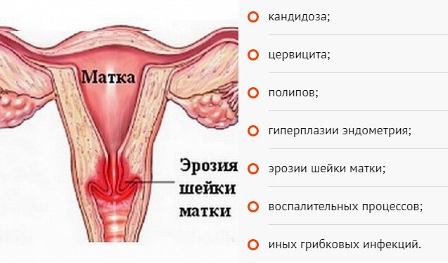  Для начала менструального цикла характерно выделение специфического секрета, который является нормой, если имеет прозрачный или полупрозрачный цвет, не имеет запаха.-2