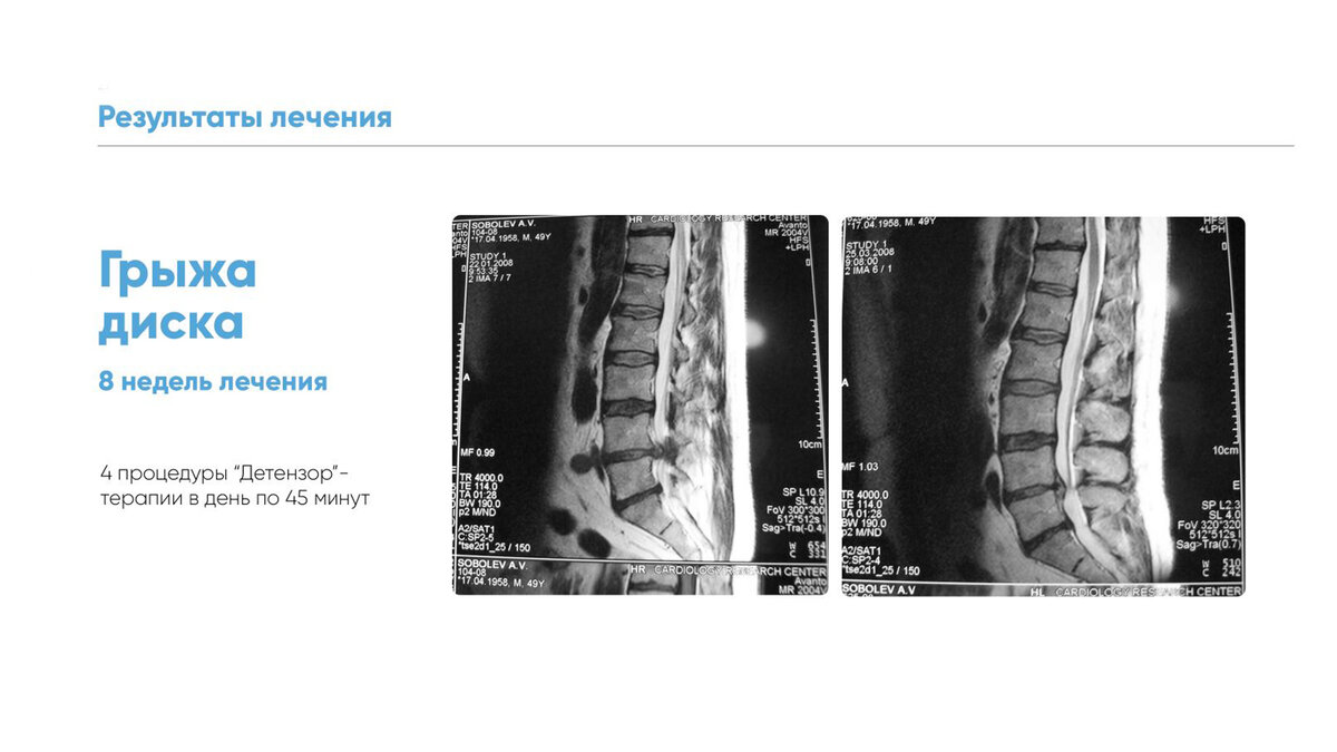 Грыжа позвоночника 8 мм. Детензерное вытяжение позвоночника. Детензор-терапия при остеохондрозе. Применение метода Детензор терапии при остеохондрозе позволяет:. Вытяжение позвоночника Детензор отзывы.