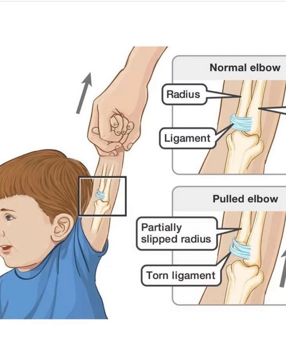 Вывихи и растяжение связок у детей