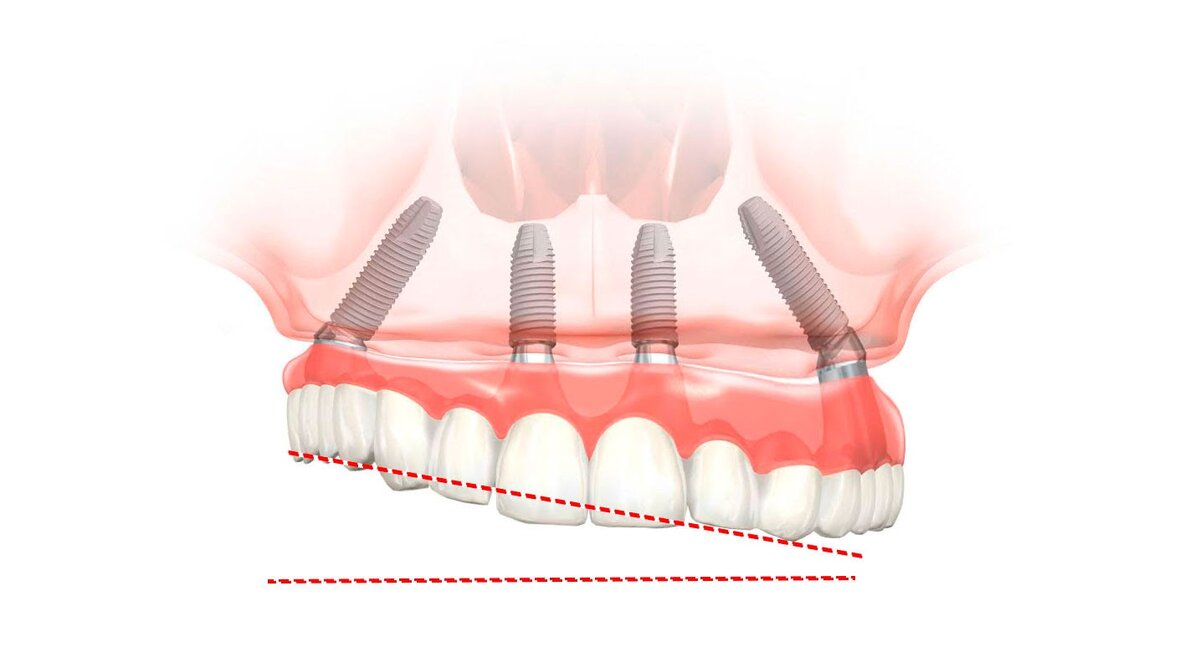 Действительно ли при all-on-4 протез может так скривиться из-за атрофии костной ткани? Спешим развеять миф: нет, так быть не может. Фото: Smile-at-Once.