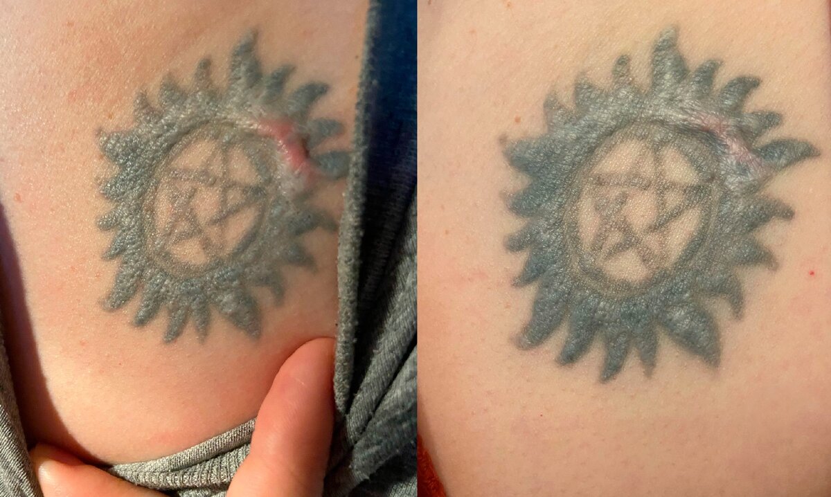 Тату после лазера и тату после инъекции гормонов.