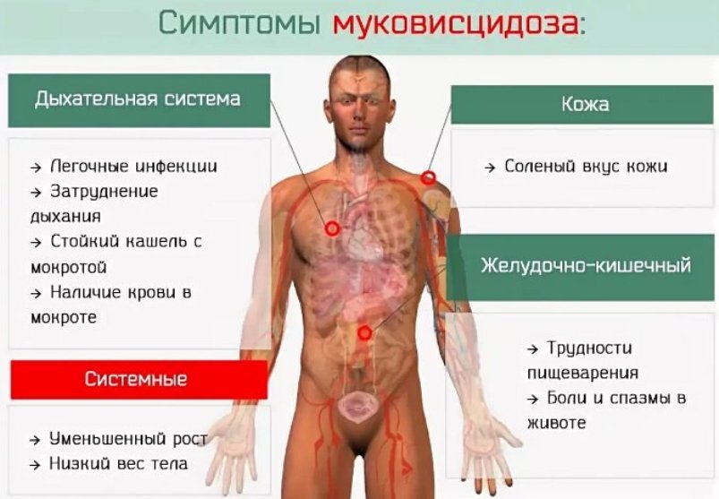 При каком заболевании появляется. Муковисцидоз клинические проявления. Муковисцидоз клинические симптомы. Муковисцидоз основные клинические проявления. Клинические проявления муковисцидоза у детей.