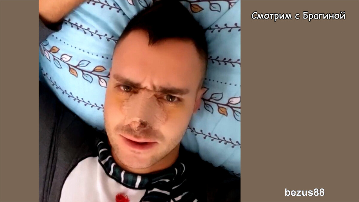 Безус отремонтировал нос, инстаграм