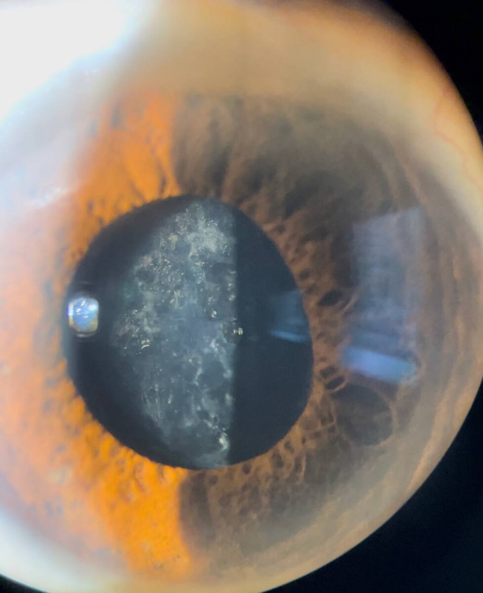 Вторичная катаракта