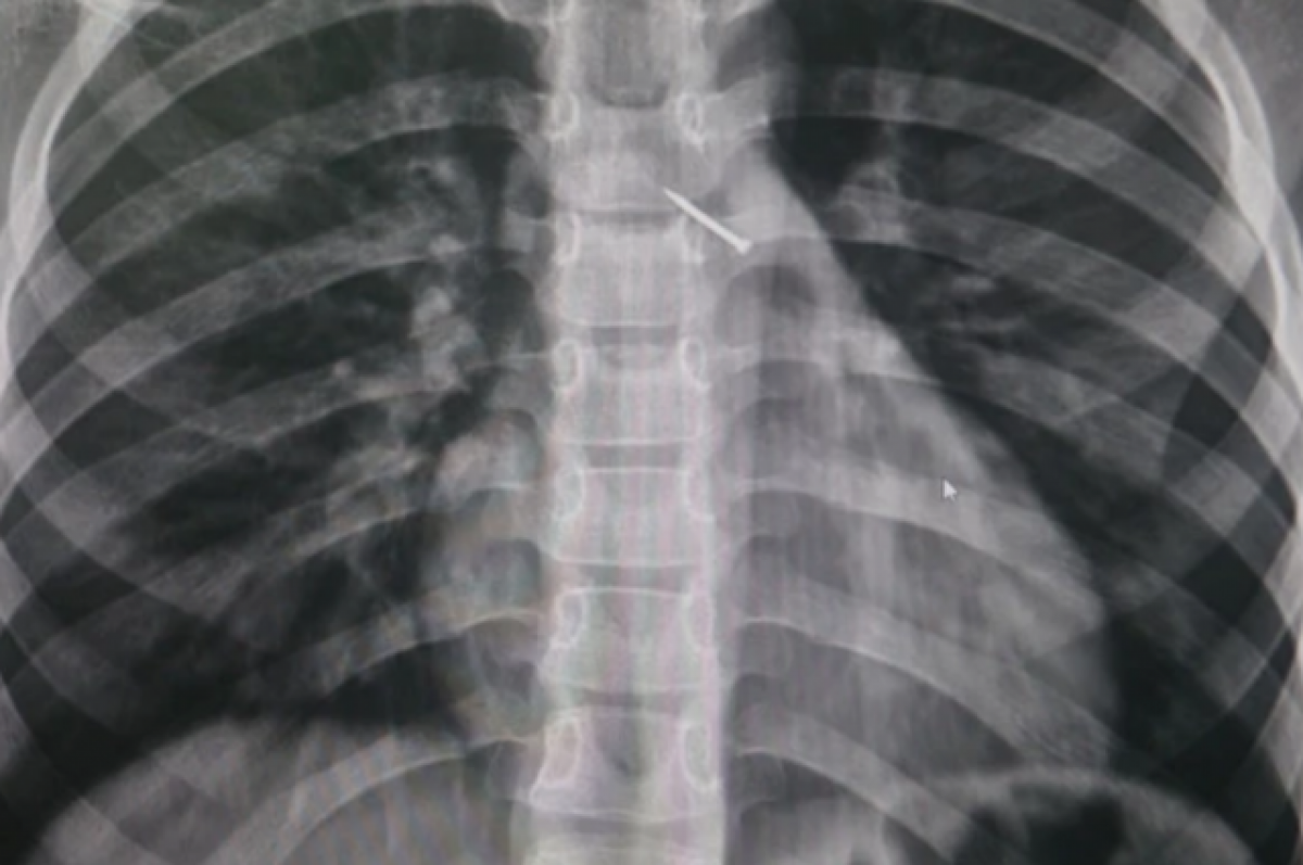    В Новосибирске 9-летний мальчик на улице вдохнул канцелярскую кнопку