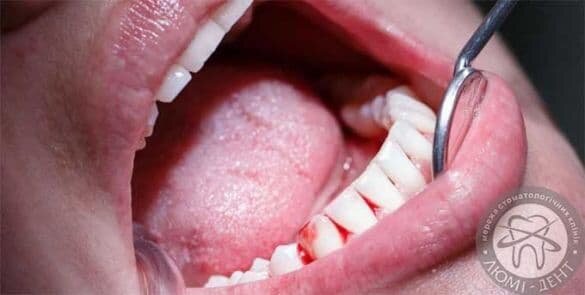 Кровотечение десен