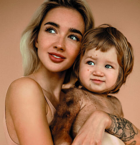 Этот улыбчивый появился на свет с редкой и опасной мутацией — его тело покрыто волосами и темными пятнами. Чтобы помочь ребенку справиться с диагнозом, неравнодушные за день собрали 3 миллиона рублей