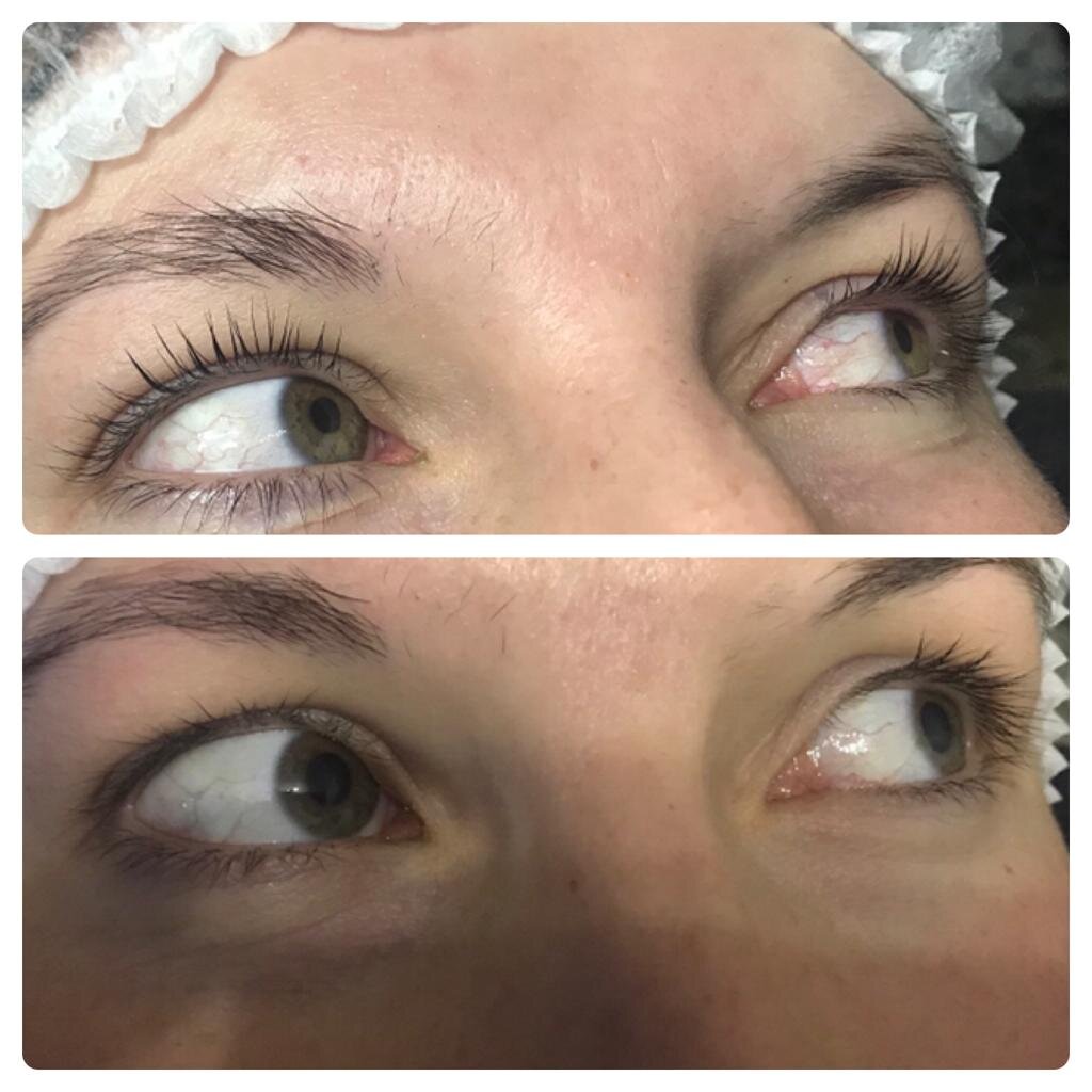 До и после процедуры