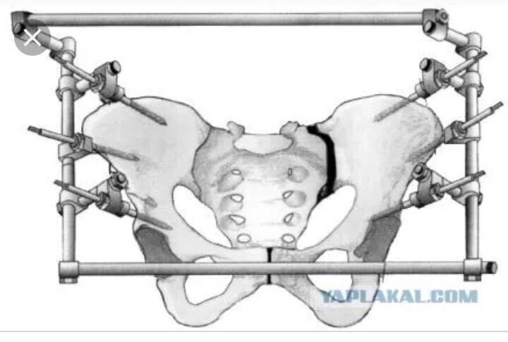 Первая при перелом кости таза
