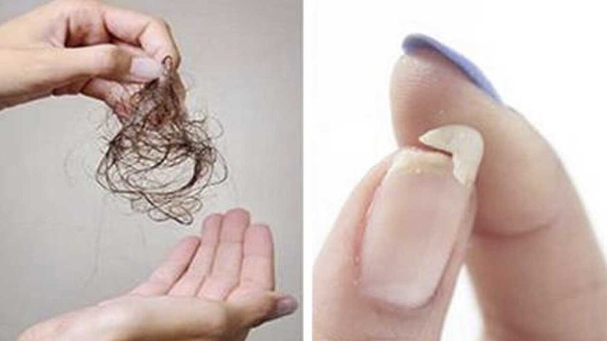 Из-за чего выпадают волосы и ломаются ногти причины и лечение