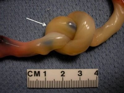 Вот такой узелок красовался на пуповине у моей крохи