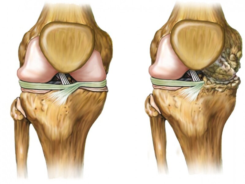 Остеоартроз коленного сустава