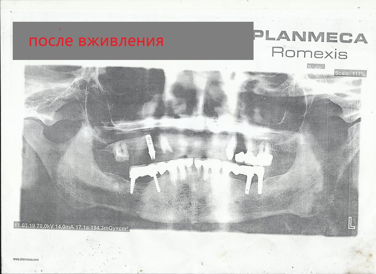              рентгеновский снимок до протезирования(вживление имплантантов)