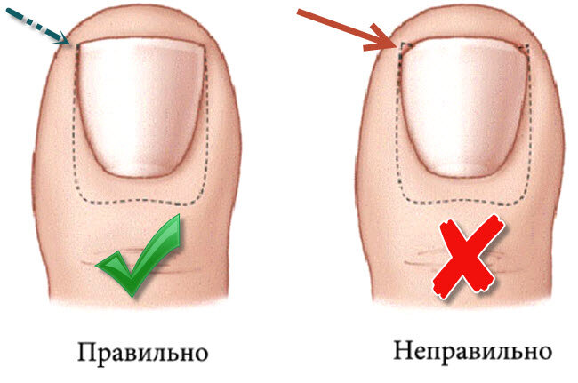 Как правильно стричь ногти, чтобы они не врастали 
