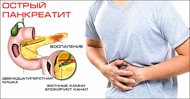 Зловонный стул при панкреатите