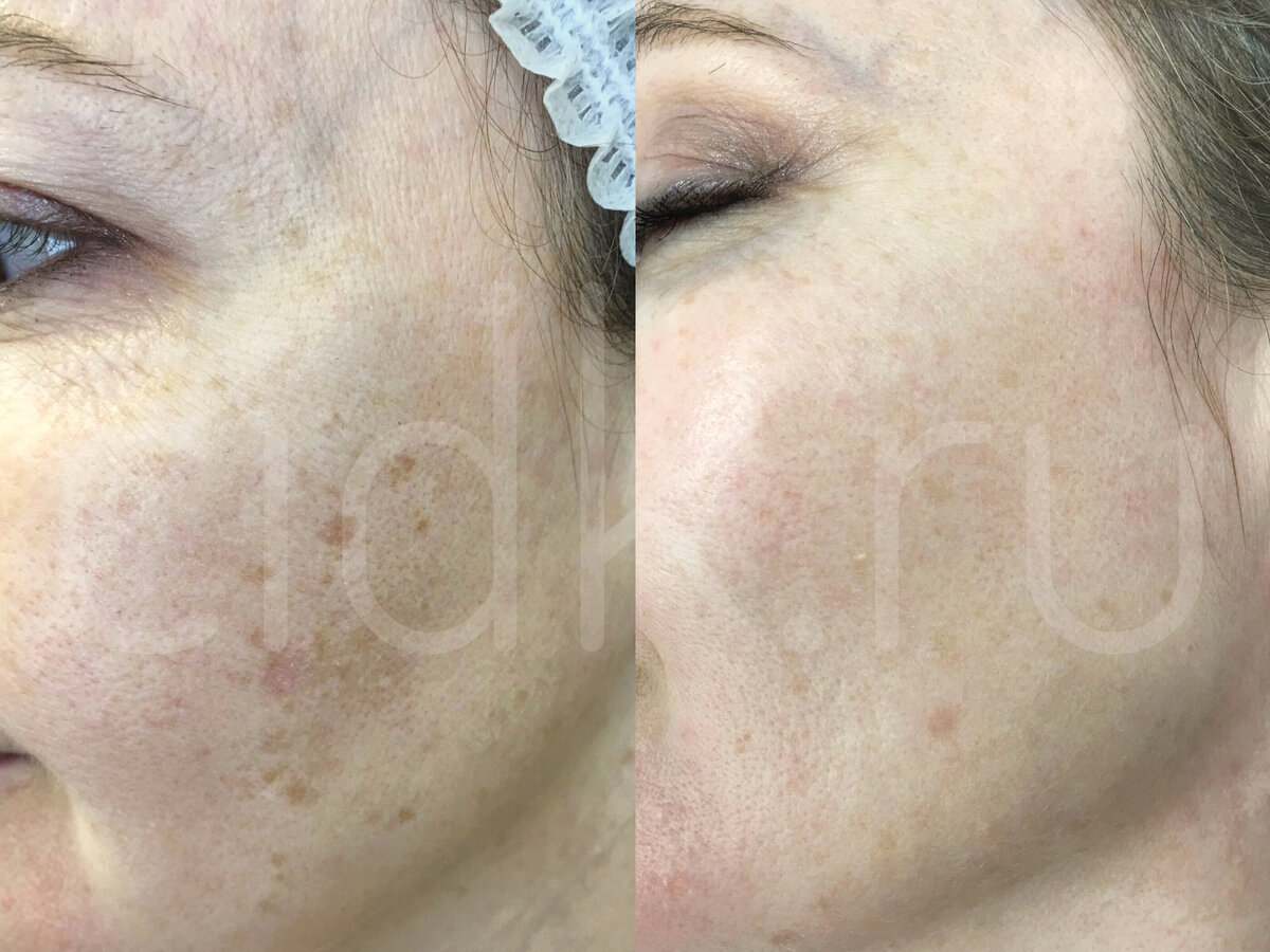 Лечение постакне / пигментация постакне