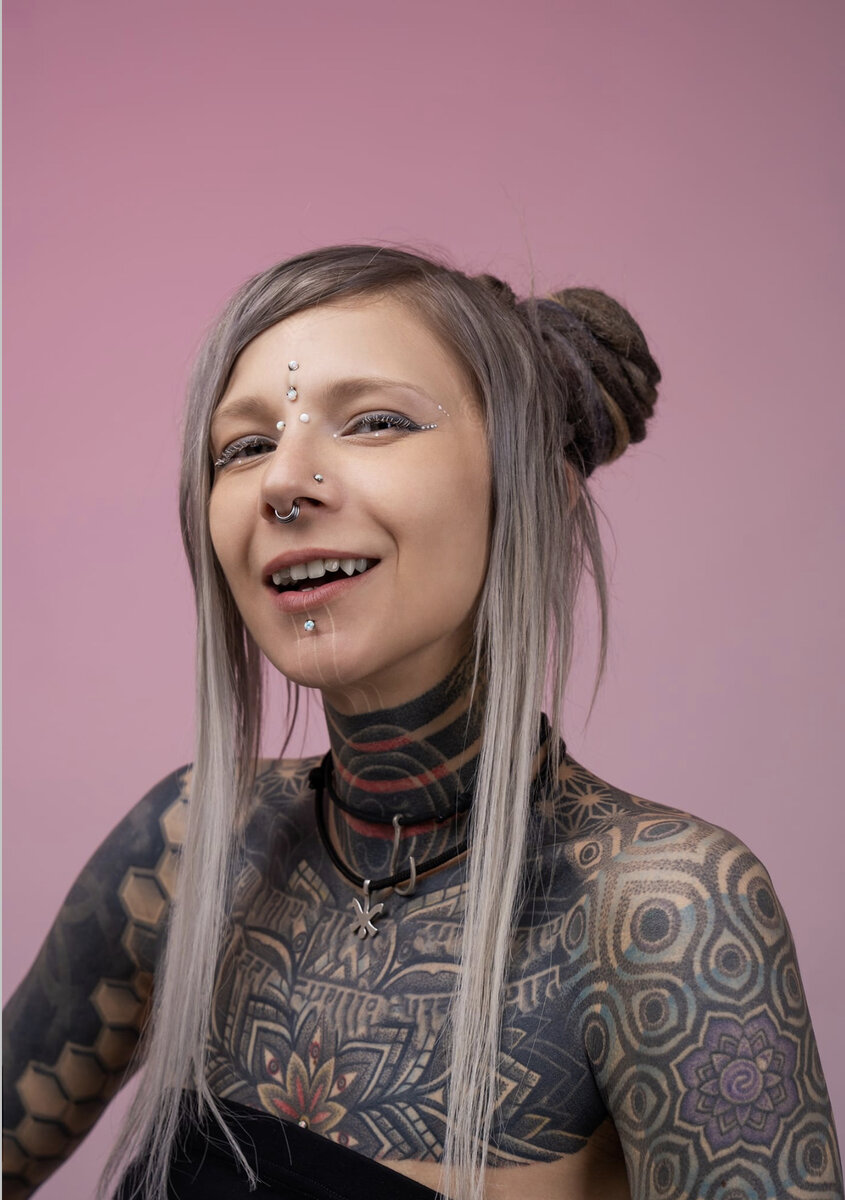 Зажившие микродермалы с накрутками в виде камней.