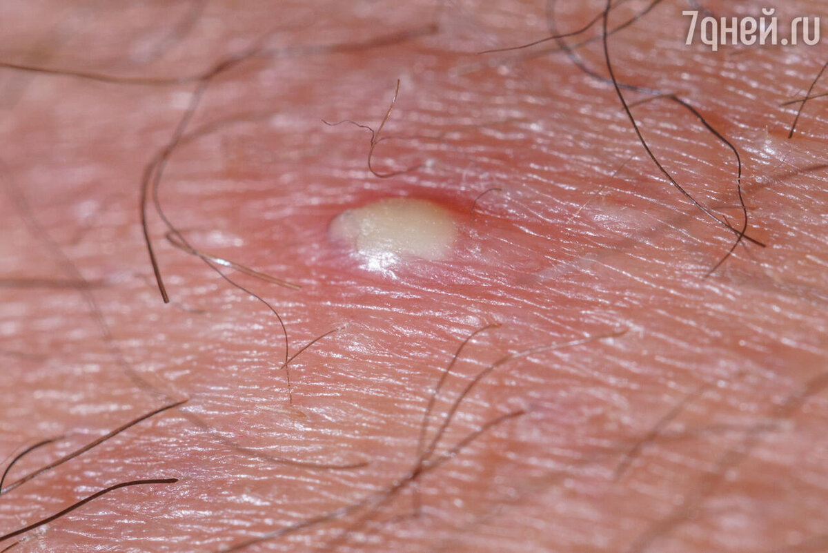    К чему снится гной 123RF/legion-media.ru