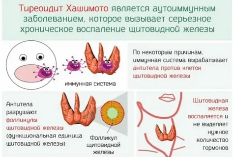 Антитела к тиреопероксидазе