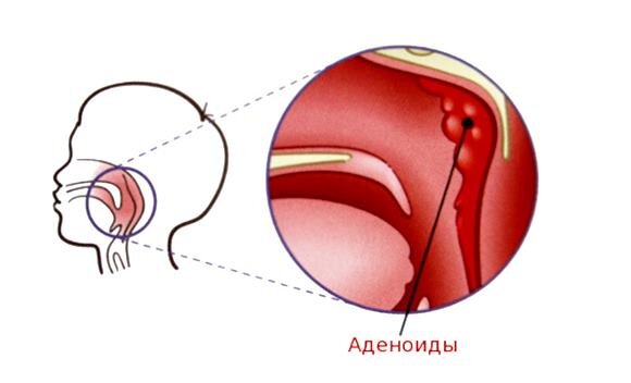 Аденоиды: причины появления, симптомы, лечение