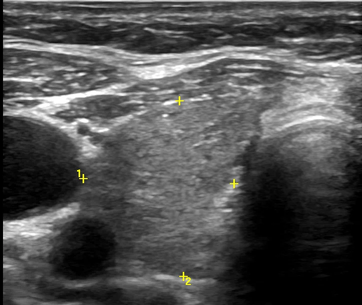 Узлы щитовидной железы на УЗИ. Узел в щитовидной железе на УЗИ. Лимфома щитовидной железы УЗИ УЗИ. Губчатый узел щитовидной железы на УЗИ.