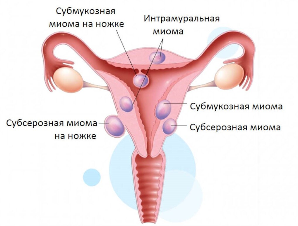 Интрамуральный миоматозный узел. Интрамурально субсерозная миома. Интрамуральная миома матки что это такое. Интрамурально субмукозная миома матки.
