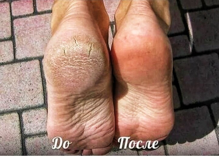 Пилинг пяток