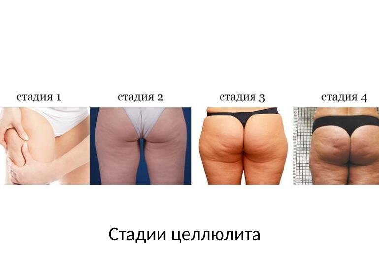 Как выглядит целлюлит внутри Почему 3 и 4 стадия целлюлита нуждается в лечении? Не запусти патологию! Info Gr