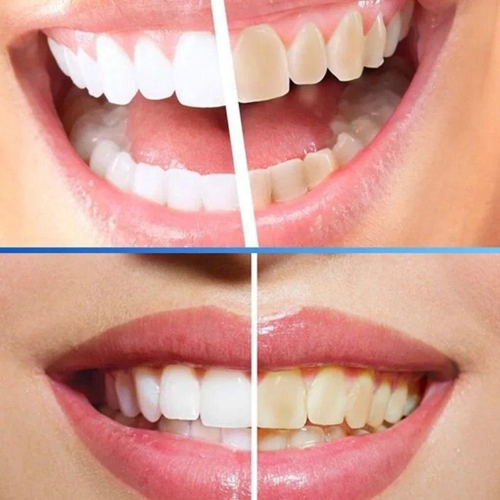 Сделать отбеливание зубов. Отбеливание зубов. Эффект от отбеливания зубов.