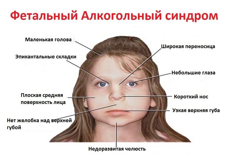 Алкогольный синдром плода – перинатальная смертность