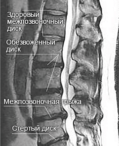 Лечение смещения диска позвоночника