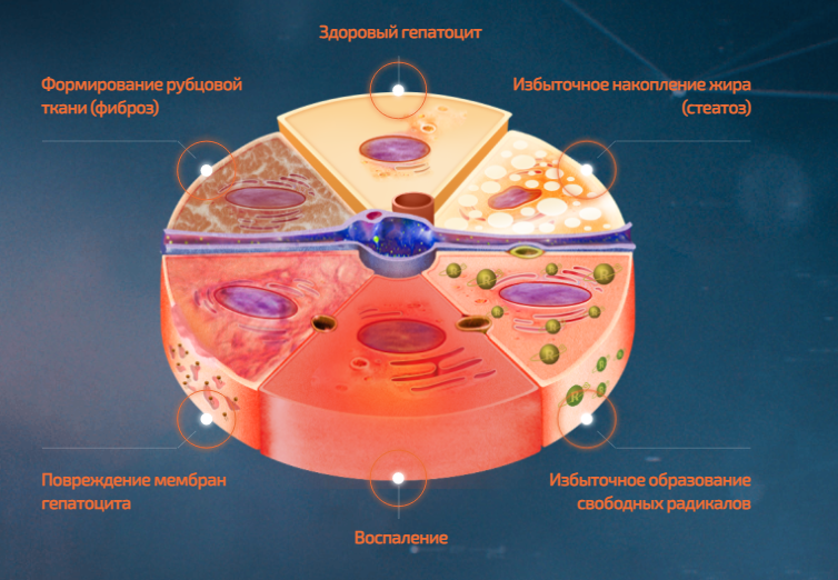 Инфографика показывает, как повреждается печень из-за избытка жира. Гепатоцит — клетка печени; свободные радикалы — вредные вещества, приводящие к воспалению органа; фиброз — образование соединительной ткани