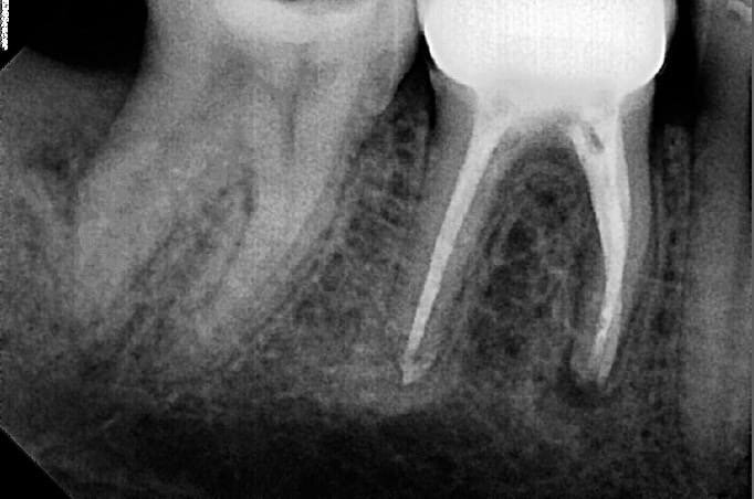 Рисунок 1. Снимок зуба