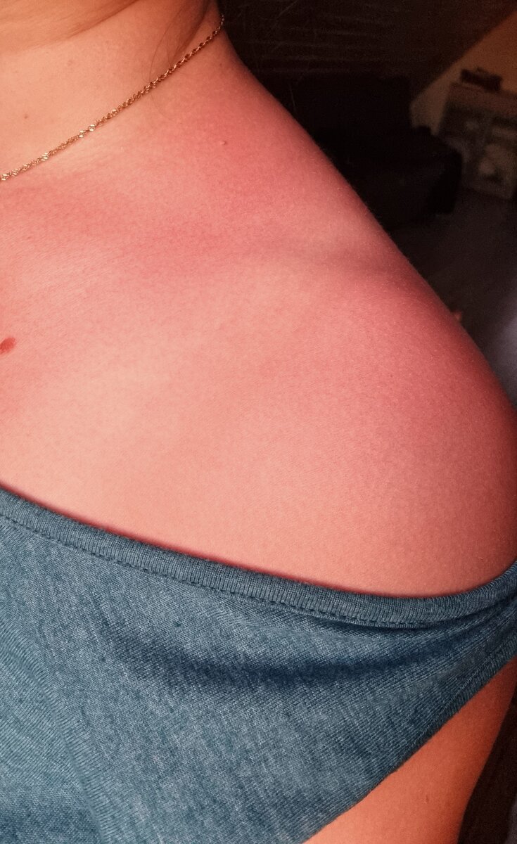 Пркраснения-это уже ожог. Он  может превратиться в красивый загар, а так же  доставить массу дискомфорта,  превратиться в волдыри и может начать слезать кожа.