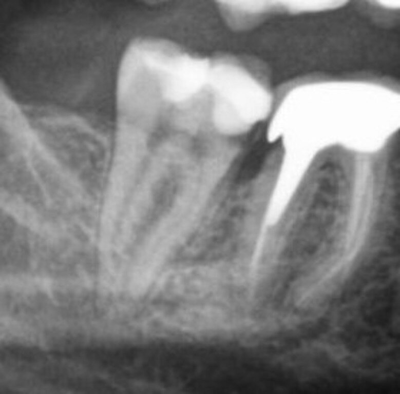 На рентгене мы видим явный нависающий край коронки