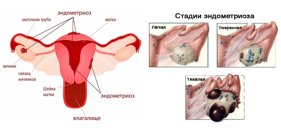 Эндометриоз: симптомы и лечение