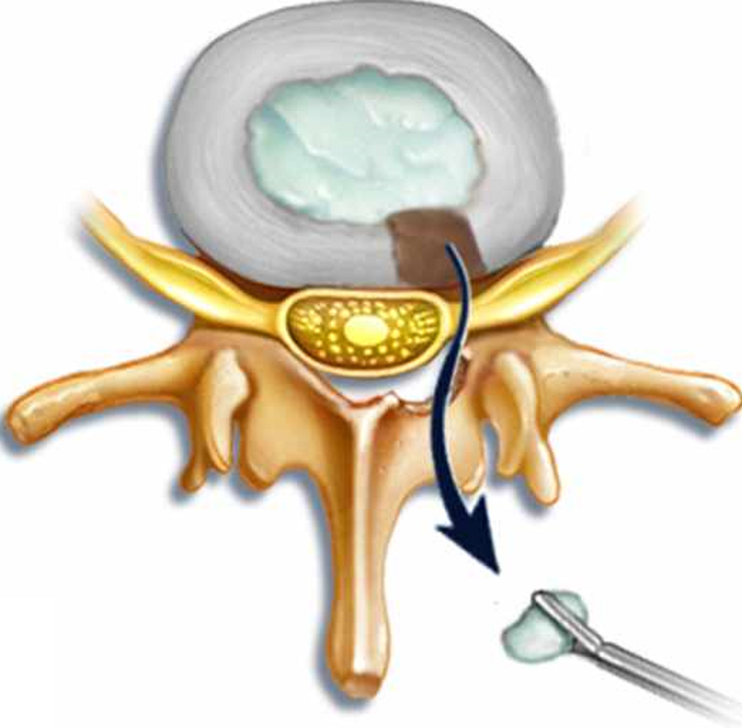 Удаление межпозвоночной грыжи. Дискэктомия с5-с6 корпородез Кейджем. Что такое дискэктомия с6 с7. Эндоскопическая дискэктомия грыжи позвоночника.