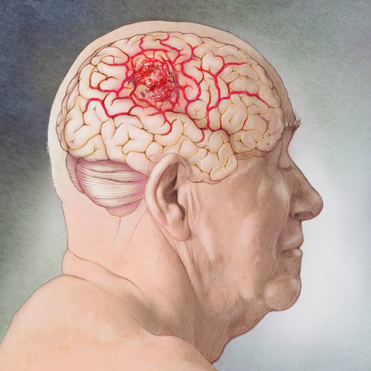 5 основных симптомов рака головного мозга | Эпидемия | Дзен