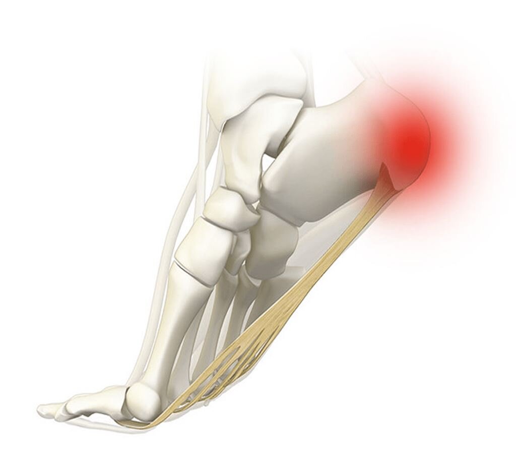 Боль в пятке при ходьбе - причины, лечение
