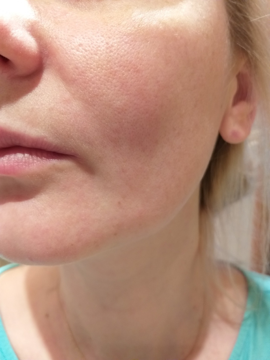 Поры раскрыты, это видно невооруженным взгядом