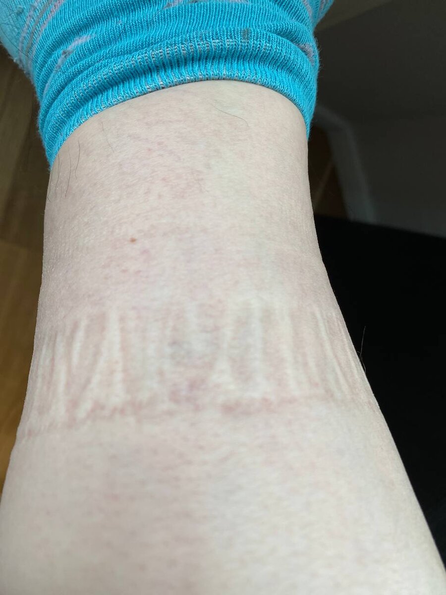 Такие следы от носков - яркий признак застоя лимфы!